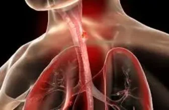 Cuáles son los síntomas del cáncer